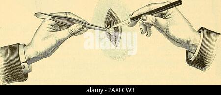 Therapeutisches Lexikon: Für praktische Ärzte. Abb. 4.. Angedeutet Weise geknotet, beide Ligaturenetwas hervorgezogen land das Gefäss zwische Fig. 5. Stockfoto