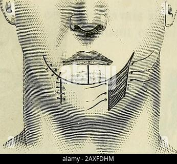 Manuel de médecine opératoire . Abb. 4-82. Procédé de Sédillot. De la commissure constitue un lambeau quadrilatère dont la baseadhérente est au menton. UN lambeau semblable est taillé de Stockfoto