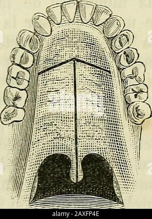 Manuel de médecine opératoire . Abb. 419. Procédé (iOllipr. Abb. 450. Procédé de Lawrence. Fendu le voile du palars de ])as en haut, cà coté de la luette; J.-L.Petit lavait fendu des deux côtés à la fois; Nélaton a ouvert à lafois le voile du palais et la voûte palatine.. Stockfoto