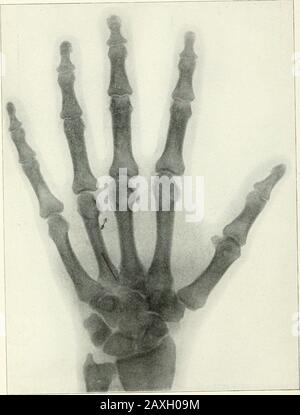 Annalen der Operation . Platte I.-Skiagraph mit in Hand und Unterarm eingebetteter Nadel; A, Position am 26. Juni. //, Position am 26. August 1896. Platte . ll.-Skiagraph zeigt zwei Nadelfragmente, die in die Hand eingebettet sind. Stockfoto