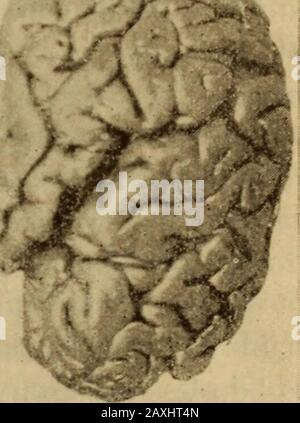 Traité des maladies de l'enfance. Poids dunhémisphère normal chez unenfant de même âge. La dimi-nution de Volume de lhémi-sphère malade est due à laréduction de tous les diamè-tres, longitudinal, transversalet oblique. 11 en Résulte une atrophie en niasse, une sorte de ratatinementgénéral de lhémisphère. La figure ci-jointe, Communiquée par P. Marie,donne la représentation photographique de la lésion et montre bien le degréexcessif que peut atteidre latrophie. Dans quelques cas, la sclérose cérébrale est bilatérale; des portions plusou moins étendues de substance cérébrale sont frappées dans Stockfoto