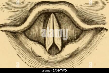 Erkrankungen des Rachens und der Nasengänge; ein Leitfaden zur Diagnose und Behandlung von Affektionen des Pharynx, des Sophragus, der Luftröhre, des Kehlkopfes und der Narben. , da die Lähmung durch die Läsion verursacht wird, ist Ofenin selbst tödlich. Behandlung*-Diese Form der Lähmung ist normalerweise deuteropathisch, es ist notwendig, dass die Behandlung auf die Kausallesion geleitet wird. Wenn es Hinweise auf einen teilweisen normalen Bewegungsaufwandes gibt, kann man versuchen, ihn durch direkte Erregung mit dieser Form von elektrischem Strom zu erhöhen, auf den er am meisten reagiert, wobei die Kontinuität von Theresulten abhängt. In Fällen von Stockfoto