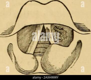 Erkrankungen des Rachens und der Nasengänge; ein Leitfaden zur Diagnose und Behandlung von Affektionen des Pharynx, des Sophragus, der Luftröhre, des Kehlkopfes und der Narben. Ngoftbeau* pr.1:it .1(111 652 AFFEKTIONEN DES KEHLKOPFES UND DER LUFTRÖHRE. Seite (Schwein. 194). Und die Pronation erfolgt somit. In den Fällen, in denen die supraarytenoiden Gewebe mit großer Tumeflaktion befallen sind.wie bei der Tuberkulose sind die Erscheinungen ähnlich (Abb. 195 und. Stockfoto