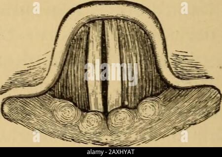 Erkrankungen des Rachens und der Nasengänge; ein Leitfaden zur Diagnose und Behandlung von Affektionen des Pharynx, des Sophragus, der Luftröhre, des Kehlkopfes und der Narben. Abb. 185.-Bilaterale Lähmung von Thyreoarytenoidsin akute Kehlkopfentzündung (Ziemssen). Abb. 1S6.-Einseitige Lähmung der (rechten) Thyreoarytenoide (Ziemssen) und Stimmaufwand ist ermüdend oder sogar schmerzhaft. Wenn eine assoziatedmit Lähmung anderer Muskeln im Bereich des Nervus inferiorlaryngealis assoziiert wird, gibt es Dysphonie oder Aphonie, wie es vielleicht der Fall ist. Stockfoto