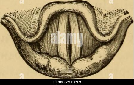 Erkrankungen des Rachens und der Nasengänge; eine Anleitung zur Diagnose und Behandlung von Affektionen des Pharynx, des Sophragus, der Luftröhre, des Kehlkopfes, Und erzählt . der Cricoidknorpel auf der Schilddrüse nach oben und nach vorne zu ziehen, ist als lokale gymnastische Übung manchmal nützlich, besonders in jenen Kasesinen, in denen die Lähmung mit Lähmung der Lateralkrico-Arytenoide in einer häufigen Form von Aphonie verbunden ist. Lähmung der Thyro-Arytenoiden Muskeln (Relaxoren von thevocalen Schnüren).-Diese Form der Lähmung ist sehr häufig, und vielleicht bilateral oder einseitig. Es ist manchmal mit einer Widerparalyse des an verbunden Stockfoto