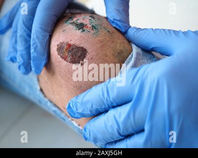 Der Arzt untersucht die heilende Wunde des Patienten auf dem Bein vom Knie zerrissen jeans Schrammen Stockfoto