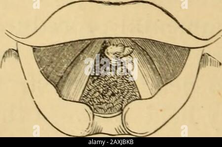 Erkrankungen des Rachens und der Nasengänge; ein Leitfaden zur Diagnose und Behandlung von Affektionen des Pharynx, des Sophragus, der Luftröhre, des Kehlkopfes und der Narben. Abb. 137.-Tobers verdeckter Halter für geschmolzene Ätznatter (Tobold). Im gewünschten Moment nach vorne gedrückt, um die Ätznatter freizulegen(Abb. 137). Die Londoner Paste (S. 196) ist der von Dr. Mackenzie, London, vorausgeführte Escharotic. Die zugehörigen Abbildungen (Abb. 13S und 139) stellt die Art der Growths dar, die für die Behandlung mit Ätzmitteln geeignet sind. Stockfoto