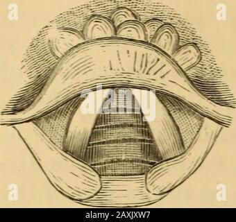 Erkrankungen des Rachens und der Nasengänge; ein Leitfaden für die Diagnose und Behandlung von Affektionen des Pharynx, des Sophragus, der Luftröhre, des Kehlkopfes und der Narben . bloße Fissur, zur nekrotischen Zerstörung aller Gewebe; und zwischen diesen extremen kann es jedes possi-ble Stadium der Abstufung geben. Der Ursprung der Ulzeration liegt in Notalwegen, die auf die bloße Entzündung der Schleimhautmembran zurückzuführen ist, die oft als fortlaufende Entzündung der Schleimdrüsen zu betrachten ist, die schließlich untergodrosig ist, und durch sie ulzerieren. Der Druck von swol-len Oberflächen in den Akten von Phonation und Co Stockfoto