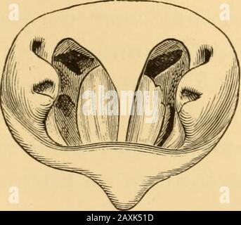 Erkrankungen des Rachens und der Nasengänge; ein Leitfaden zur Diagnose und Behandlung von Affektionen des Pharynx, des Sophragus, der Luftröhre, des Kehlkopfes und der Narben. Abb. 95.-Rhinosoopisches Bild der Zedema onasalen Septum. Abb. 96.-Rhinoskopisches Bild von Ödemen der Nasenscheidewand. Stockfoto