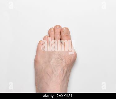 Nahaufnahme des linken, rechten Fußes mit Bunion, Hallux valgus, auf großer Zehe, was zu Deformität führt Stockfoto