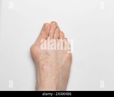 Nahaufnahme des linken, rechten Fußes mit Bunion, Hallux valgus, auf großer Zehe, was zu Deformität führt Stockfoto