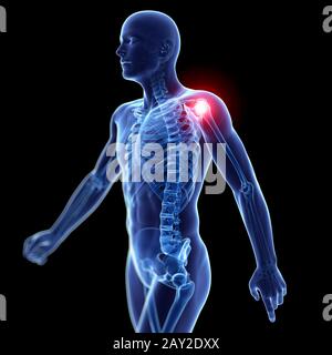 3D gerenderte Darstellung der schmerzhaften Schulter Stockfoto