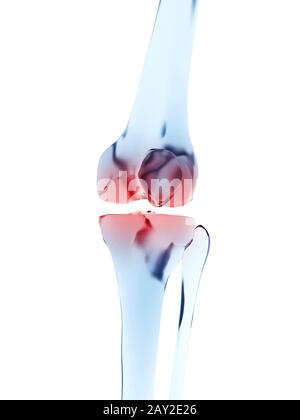 medizinische Illustration von einer schmerzhaften Knie Stockfoto