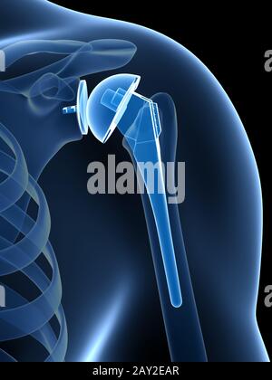 3D gerenderte Darstellung der Schulter Ersatz Stockfoto