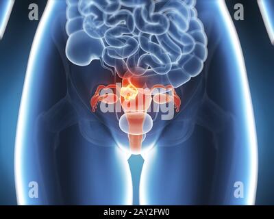 3D gerenderten Illustration - Gebärmutterkrebs Stockfoto