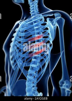 medizinische Illustration der gebrochenen Rippen Stockfoto