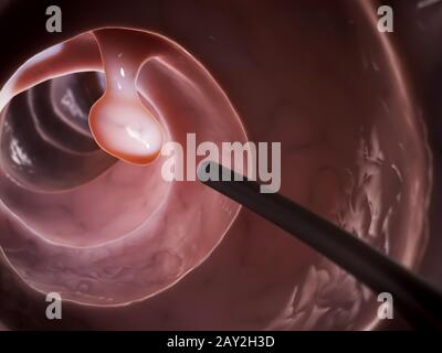 3D gerenderte Darstellung einer Darmspiegelung Stockfoto