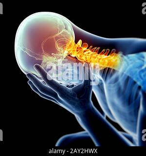 Kopfschmerzen aufgrund von Nackenschmerzen Stockfoto