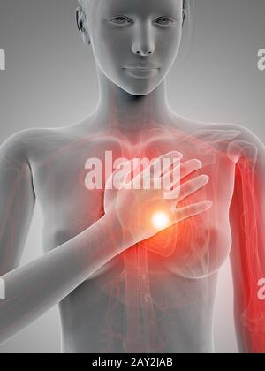 Medizinische 3D-Darstellung - Herzinfarkt Stockfoto