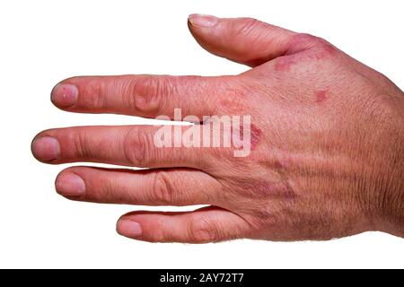 Menschliche Hand mit Ausschlag/Ekzem isoliert auf Weiß Stockfoto