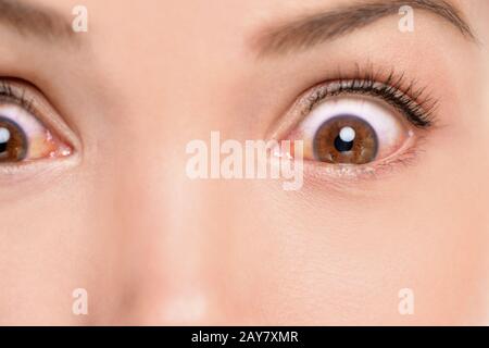 Rote Augen Frau mit allergischer Reaktion Bindehautentzündung reizte Blutaugenentzündung. Nahaufnahme einer schockierten, aufgebrachten Person mit medizinischer Probleminfektion. Stockfoto