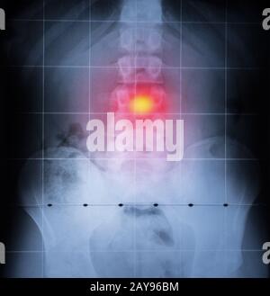 X-ray, der Wirbelsäule und des Beckens des menschlichen Körpers. Rückenschmerzen in rot markiert Stockfoto