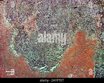 Histologischer Gewebeschnitt eines Malanoms, Hautkrebs, 200-fach Stockfoto