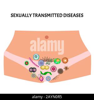 Virale und bakterielle Infektionen. Sexuell übertragbare Krankheiten. Infografiken. Vektordarstellung auf isoliertem Hintergrund. Stock Vektor