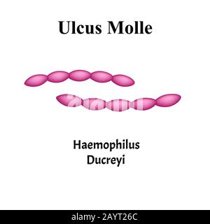 Ulcus Molle, Haemophilus ducreyi. Bakterielle Infektionen. Sexuell übertragbare Krankheiten. Infografiken. Vektordarstellung auf isoliertem Hintergrund. Stock Vektor