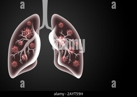 Atemvirus und Coronavirus Ausbruch. Coronavirus oder COVID-19, das Virus, das Pneumonie verursacht, als medizinisches Gesundheitsrisiko mit infizierter menschlicher Lunge Stockfoto