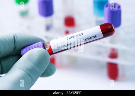 Blutprobenschlauch in der Hand mit positivem Coronavirus Test Stockfoto