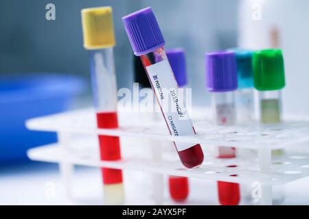 Blutprobenschlauch mit positivem Coronavirus-Test im Labor Stockfoto