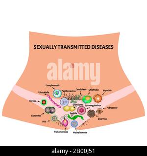 Virale und bakterielle Infektionen. Sexuell übertragbare Krankheiten. Infografiken. Vektordarstellung auf isoliertem Hintergrund. Stock Vektor