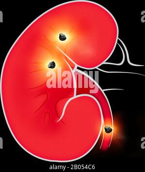 Menschliche Körperansicht der Nieren. Die Nieren sind zwei bohnenförmige Organe, die bei Wirbeltieren gefunden werden. Nierensteine Stockfoto