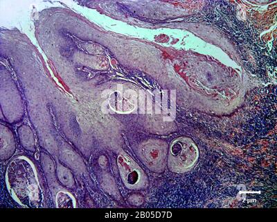 Histologischer Gewebeschnitt eines dermalen Krebses, hocken, 200-fach Stockfoto