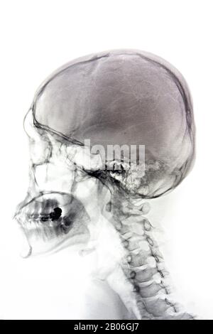 Film Röntgen Schädel und Halswirbelsäule Seitenansicht Stockfoto