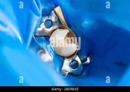 Karies. Befüllen mit zahnmedizinischen Composite photopolymer Material mit rabbders. Das Konzept der zahnärztlichen Behandlung in einer Zahnklinik Stockfoto