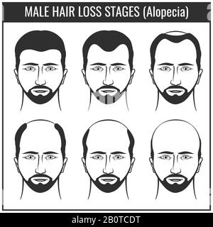 Haarausfall Phasen und Arten von Kahlheit. Man-Härchen-Problemvektor-Diagramme. Problem mit dem Haar, Abbildung des Haarausfalls Stock Vektor
