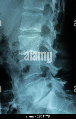 Backbone-xray-Scan Stockfoto