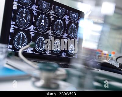 Nahaufnahme von Stethoskop und Gehirnscan auf einem Computerbildschirm. Stockfoto