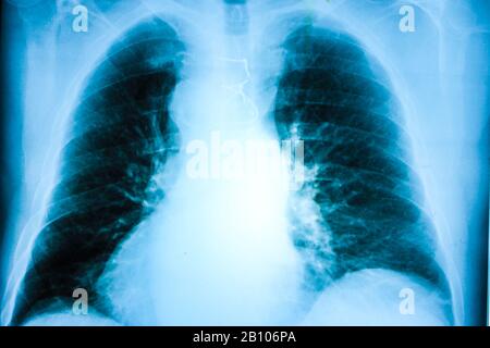 Thorax-xray-Scan Stockfoto