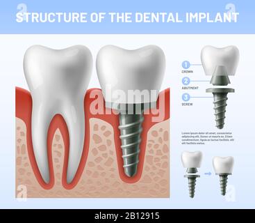Zahnimplantat. Implantationsverfahren oder Zahnkronenabutments. Vektorgrafiken im Gesundheitswesen Stock Vektor