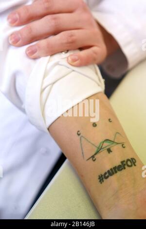 Berlin, Deutschland. Februar 2020. Nadine Großmann zeigt ihr Handgelenk-Tattoo mit dem Gen-Defekt "FOP". Das FOP, auch Münchmeyer-Syndrom genannt, beschreibt die pathologische, fortschreitende Ossifikation des Bindegewebes und Stützgewebes des menschlichen Körpers. Der 29. Februar 2020 ist der Tag seltener Krankheiten. (Zur dpa 'Berliner recherchiert ihre eigene seltene Krankheit') Credit: Jörg Carstensen / dpa / Alamy Live News Stockfoto