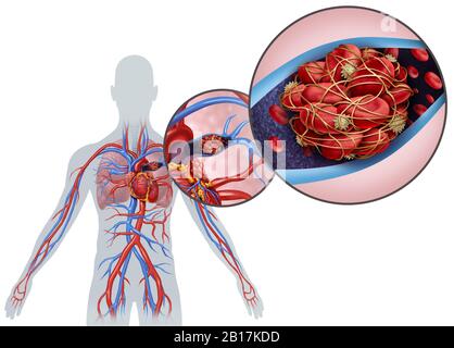 Lungenembolie mit einem Blutgerinnsel als Krankheit mit einer Blockierung einer Arterie in der Lunge mit 3D-Abbildungselementen. Stockfoto