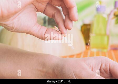 Selbst die Anwendung der Akupunktur Nadel in der Hand Stockfoto