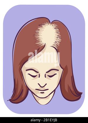 Illustration von A Girl with Female Pattern Baldness, Frontal Scalp Stockfoto