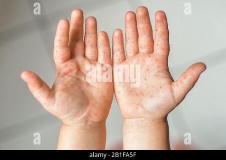 Enterovirus Bein arm Mund Ausschlag auf den Körper eines Kindes Cocksackie Virus Stockfoto