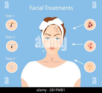 Vektor einer jungen Frau mit Gesichtsperfektionen. Infografik zu Gesichtsbehandlungen. Stock Vektor