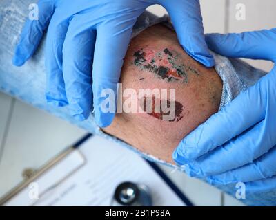 Der Arzt untersucht die heilende Wunde des Patienten auf dem Bein vom Knie zerrissen jeans Schrammen Stockfoto