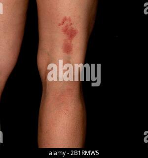 Herpes Zoster oder Schindeln Hautausschlag auf der Rückseite des Beins eines Frauen mittleren Alters, vor schwarzem Hintergrund. Schindeln ist eine Virusinfektion, die ein p verursacht Stockfoto